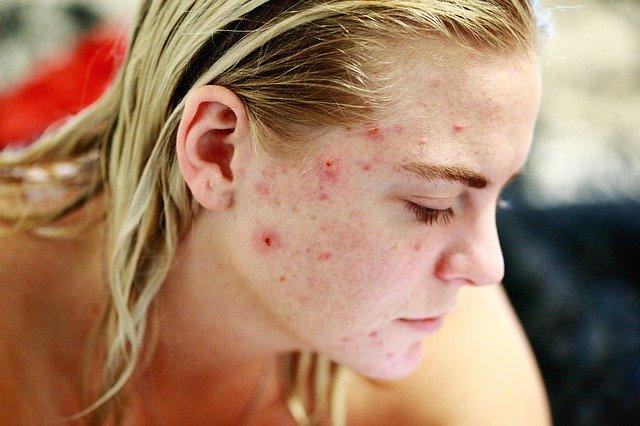 Acne, acné, pustuloso, acné Toluca, dermatólogos en Toluca, médicos de la piel, para el acné