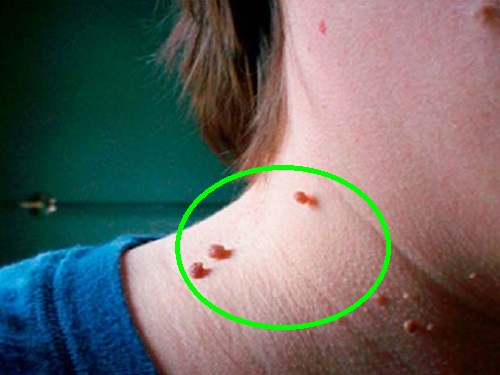 verrugas, neoformaciones, cuello con verrugas, dermatólogos en metepec