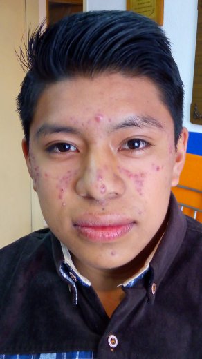 acné conglobata, acné toluca, acné metepec, tratamiento para el acne