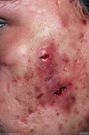 acné conglobata, conglobado, acné, pustuloso, acné Toluca, dermatólogos en Toluca, médicos de la piel, para el acné