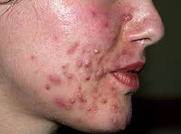 acné, pustuloso, acné Toluca, dermatólogos en Toluca, médicos de la piel, para el acné