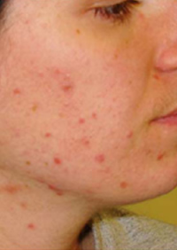 acné, pustuloso, acné Toluca, dermatólogos en Toluca, médicos de la piel, para el acné