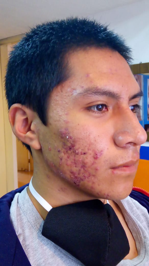 clinica de acne toluca