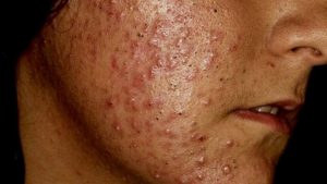acné comedónico, puntos negros,acné, pustuloso, acné Toluca, dermatólogos en Toluca, médicos de la piel, para el acné