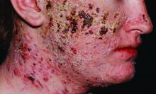 fulminante, acne fulminans, acné toluca, tratamiento para el acné