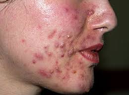 botox toluca, rejuvenecimiento facial, arrugas, dermatólogos en toluca