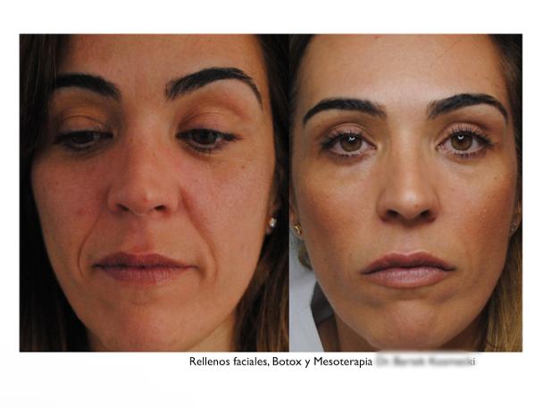 , botox, toxina botulínica, relleno facial, rellenos faciales