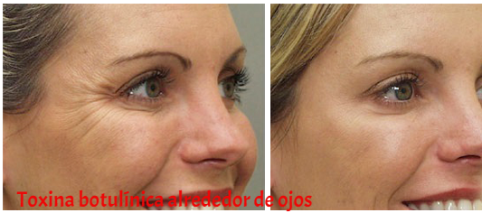 botox toluca, rejuvenecimiento facial, arrugas, dermatólogos en toluca