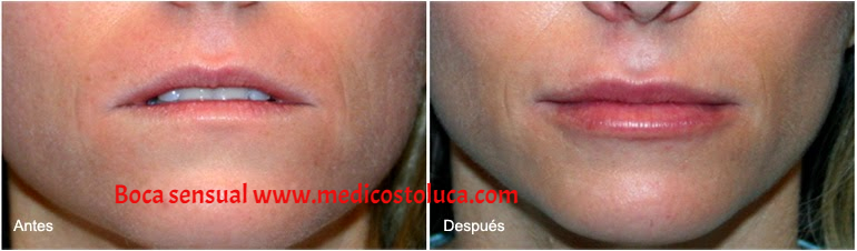 acido hialurónico, engrosamiento de labios, boca deliciosa