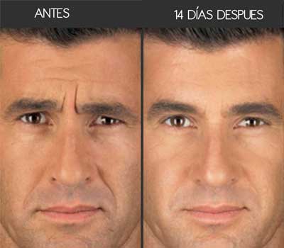 botox toluca, rejuvenecimiento facial, arrugas, dermatólogos en toluca