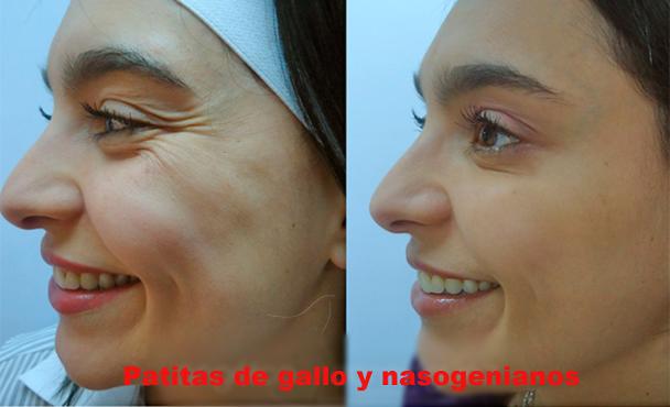 botox toluca, rejuvenecimiento facial, arrugas, dermatólogos en toluca