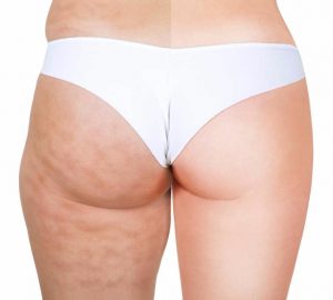 celulitis, mesoterapia, grasa localizada, lonja