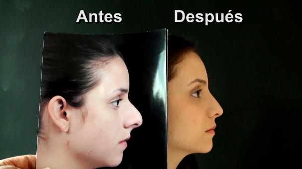 bioplastía nasal. bioplastía de naríz, plastía de naríz, naríz, corrección de nariz