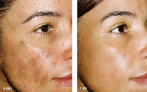 melasma, manchas, piel manchada