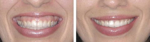 sonrisa gingival, medicina estética