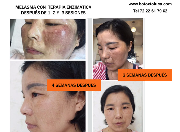 melasma, manchas, cara, dermatología