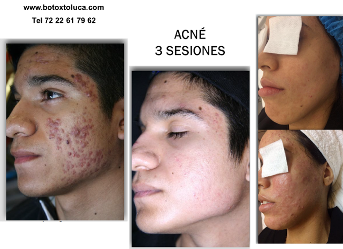 acné, piel, dermatología, cicatrices, dermatólogos en metepec