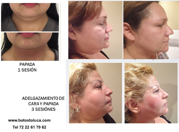 cachetes, bichectomia, acne toluca, dermatologos en toluca, papada, perfilamiento de rostro, terapia enzimática, toluca