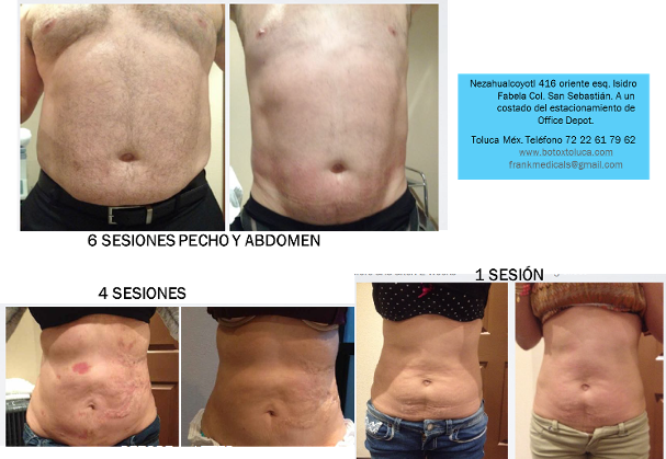 mesoterapia, grasa localizada, lonja, quemar grasa
