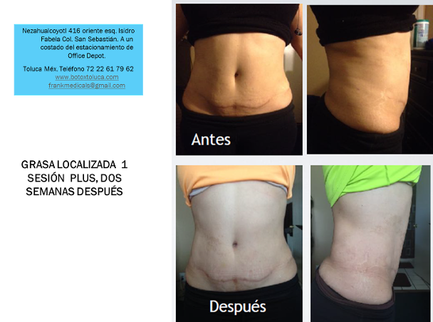 mesoterapia, grasa localizada, lonja, quemar grasa