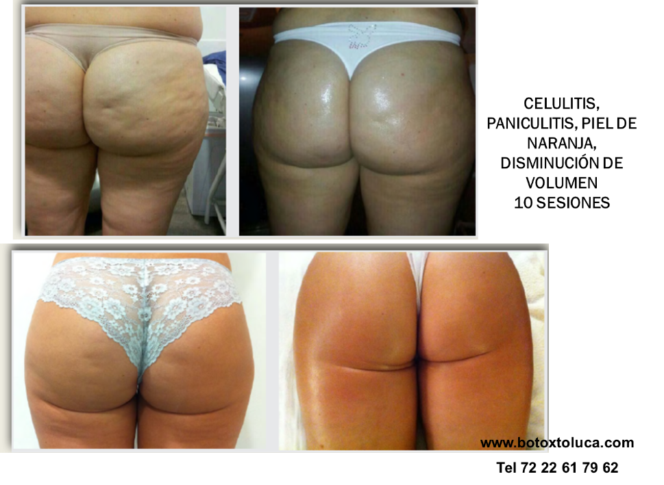 celulitis, piel de naranja,  reducción de grasa, lonja