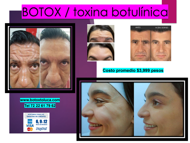 botox toxina botulinica antes y despues clinica franco