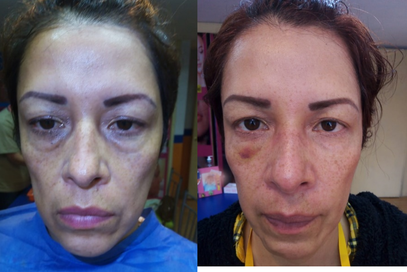 rejuvenecimiento ojera hialuronico clinica franco toluca