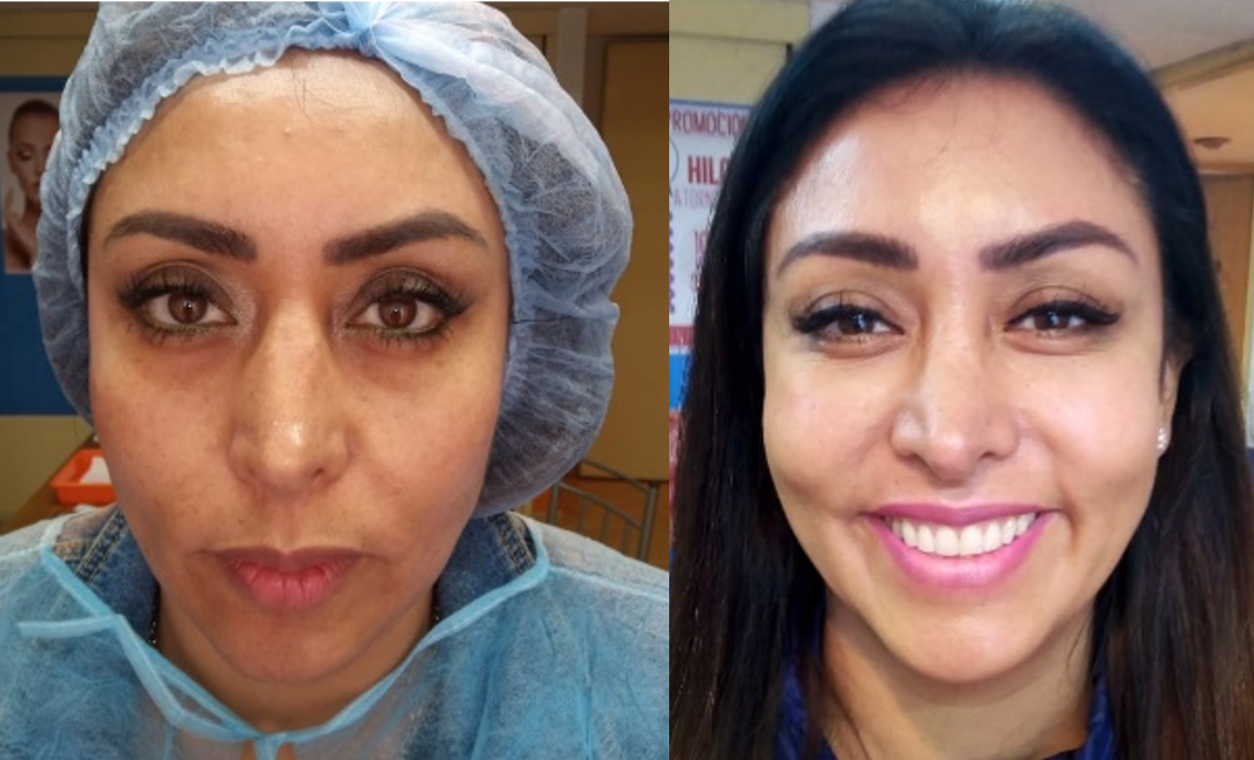 ojera y perdida de grasa del rostro relleno con acido hialuronico