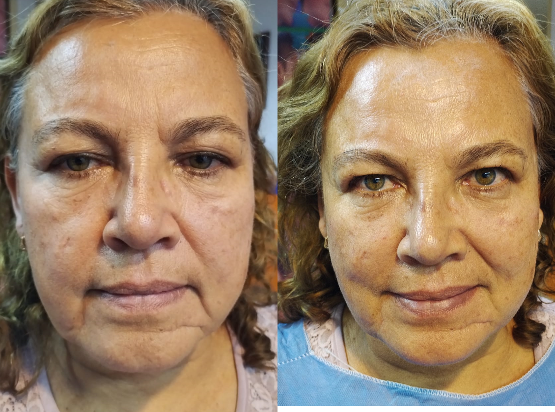 rejuvenecimiento rostro clinica franco