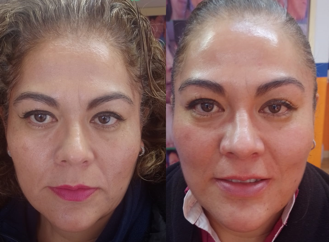 tratamiento de la ojera clinica toluca